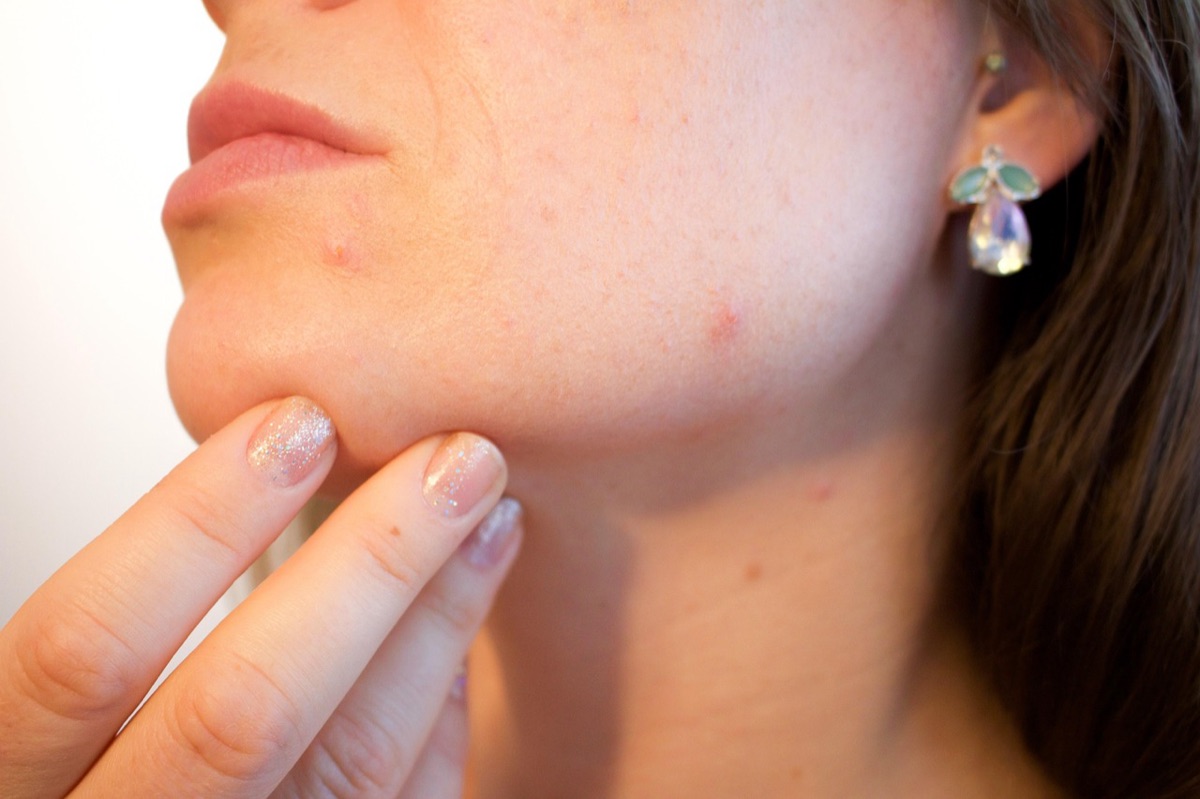Lesão de acne em microscópio