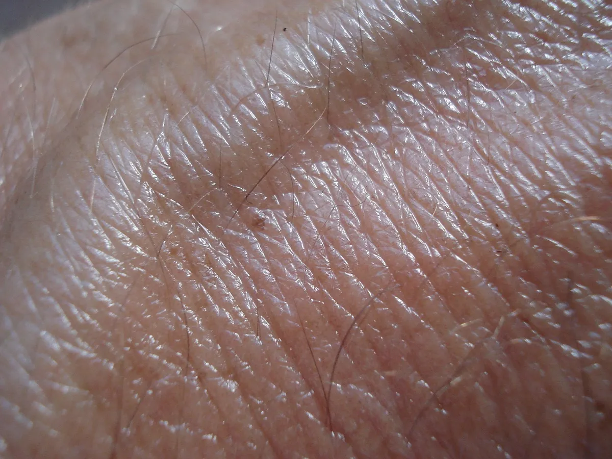 skin, vein, brown, skin cancer, human, skin cancer, skin cancer, skin cancer, skin cancer, skin cancer
